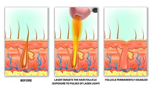 808nm Diode Laser Hair Removal - ADSS Laser